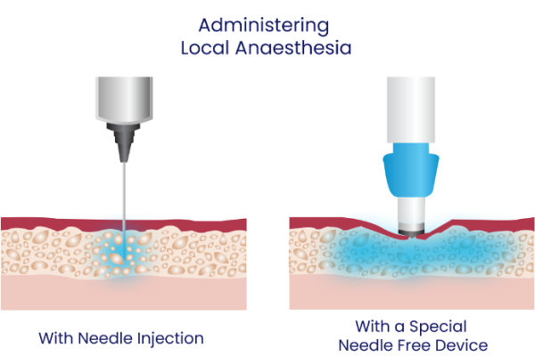 anaesthesia